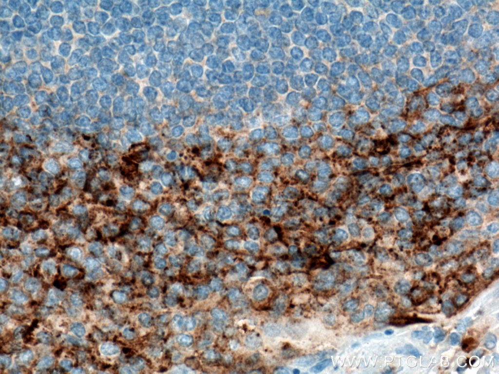 IHC staining of human tonsillitis using 10593-1-AP