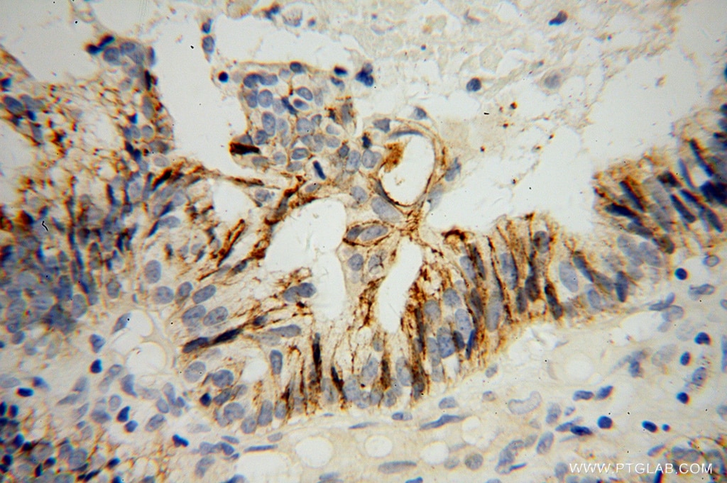 Immunohistochemistry (IHC) staining of human ovary tumor tissue using CD138/Syndecan-1 Polyclonal antibody (10593-1-AP)