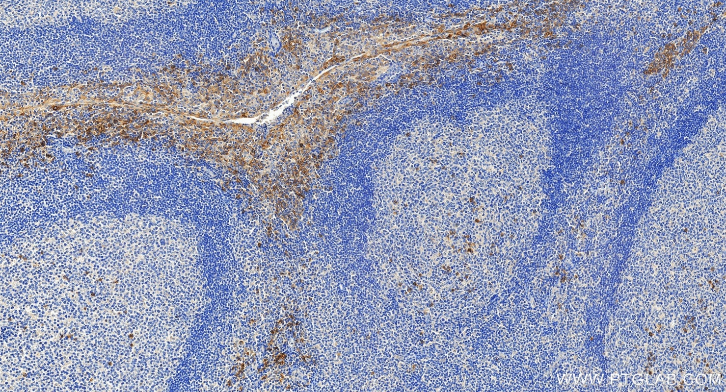 IHC staining of human tonsillitis using 10593-1-AP Immunohistochemistry (IHC) staining of human tonsillitis tissue using CD138/Syndecan-1 Polyclonal antibody (10593-1-AP)