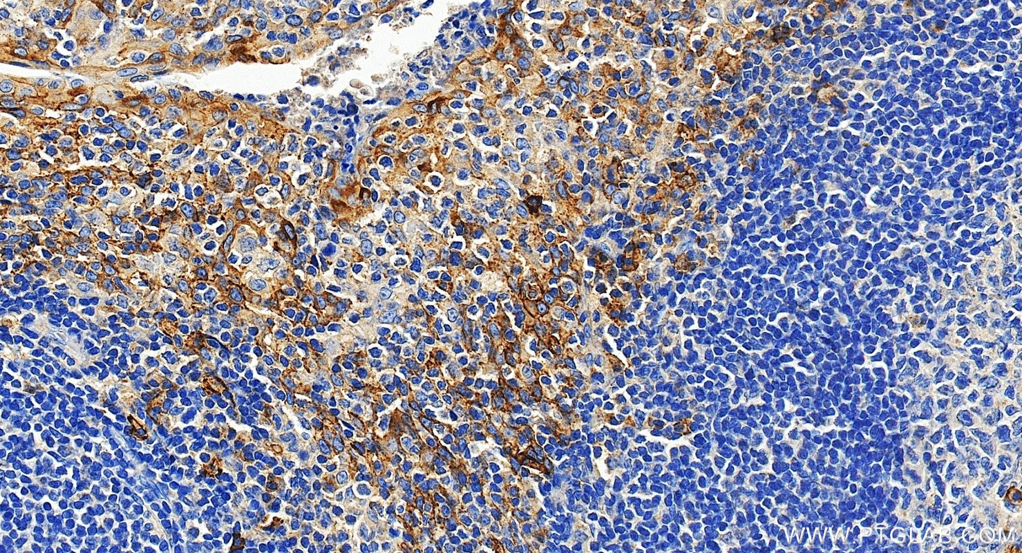 IHC staining of human tonsillitis using 10593-1-AP Immunohistochemistry (IHC) staining of human tonsillitis tissue using CD138/Syndecan-1 Polyclonal antibody (10593-1-AP)