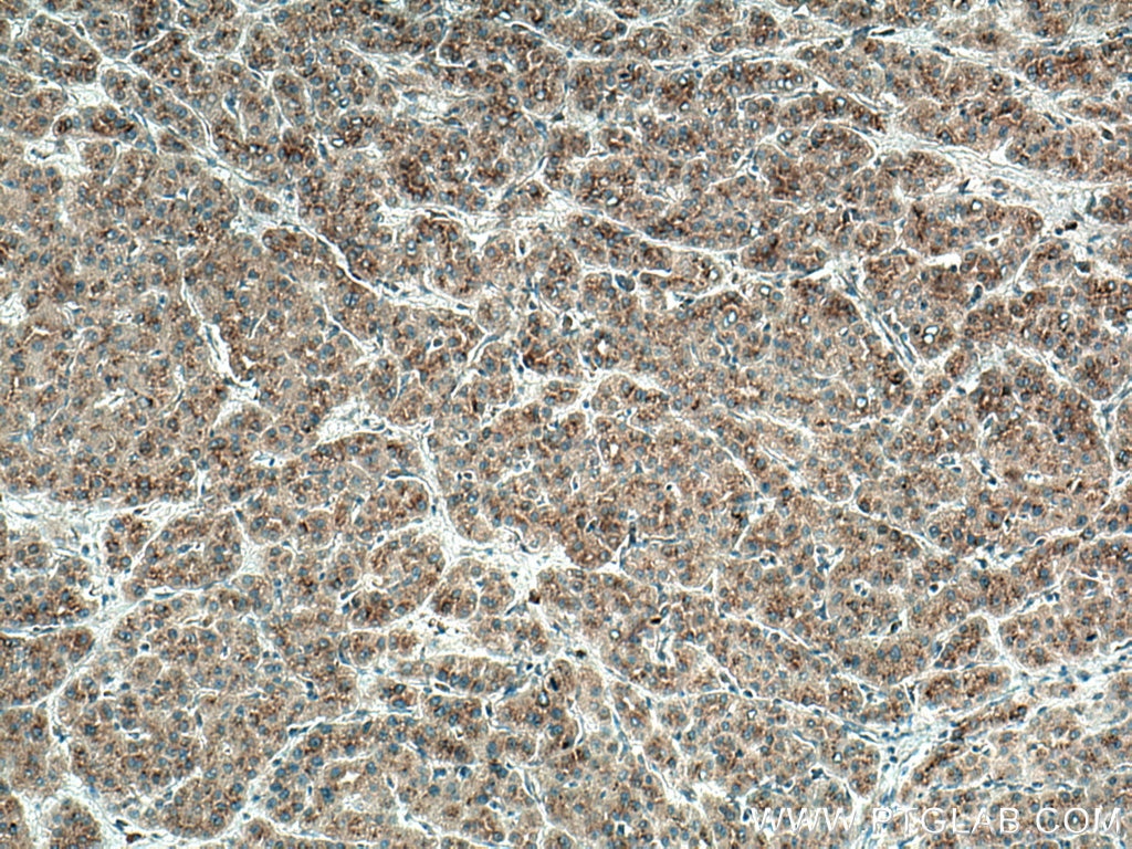 IHC staining of human liver cancer using 67088-1-Ig