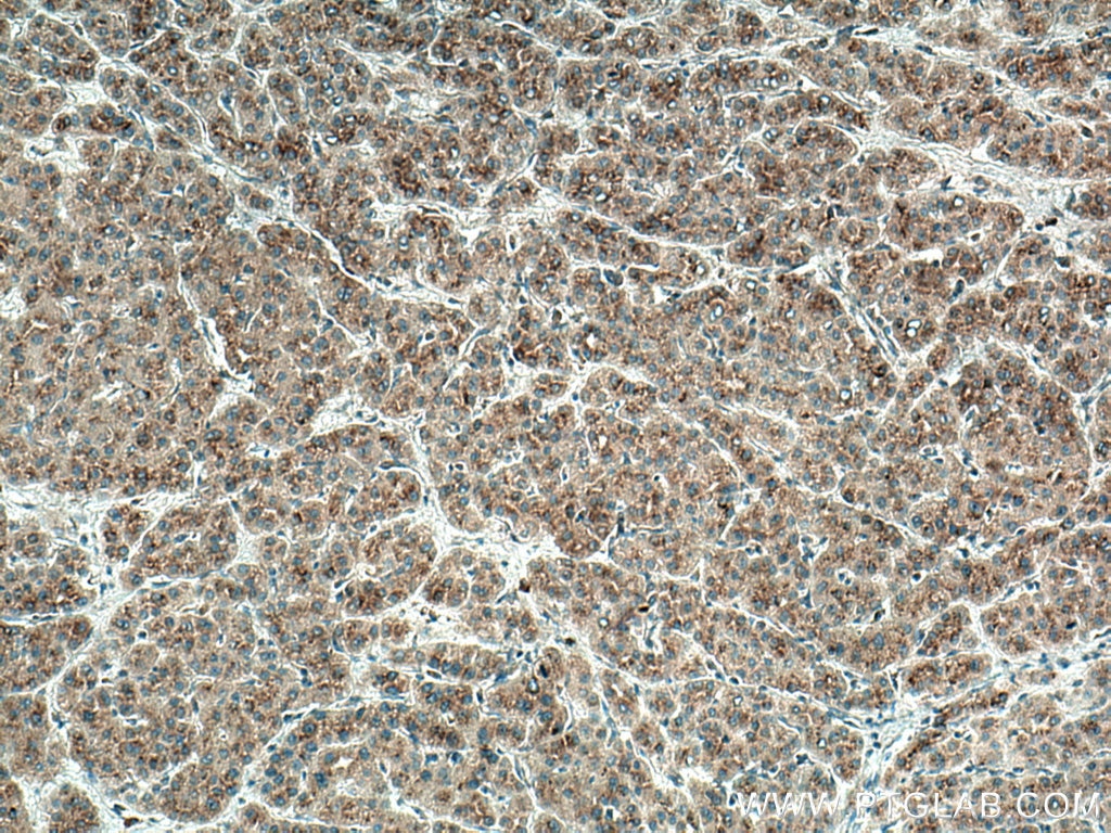 Immunohistochemistry (IHC) staining of human liver cancer tissue using SDC2 Monoclonal antibody (67088-1-Ig)