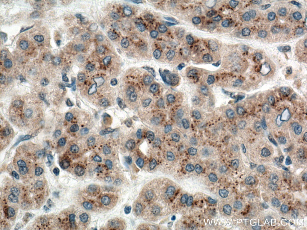 Immunohistochemistry (IHC) staining of human liver cancer tissue using SDC2 Monoclonal antibody (67088-1-Ig)