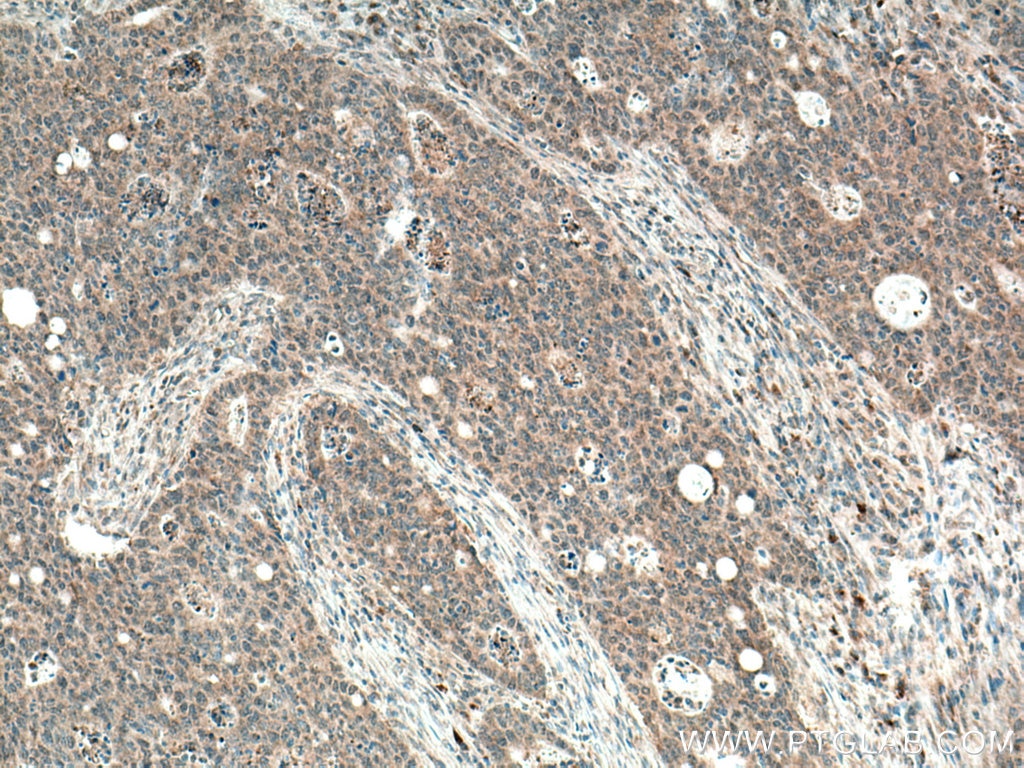 Immunohistochemistry (IHC) staining of human colon cancer tissue using SDC2 Monoclonal antibody (67088-1-Ig)