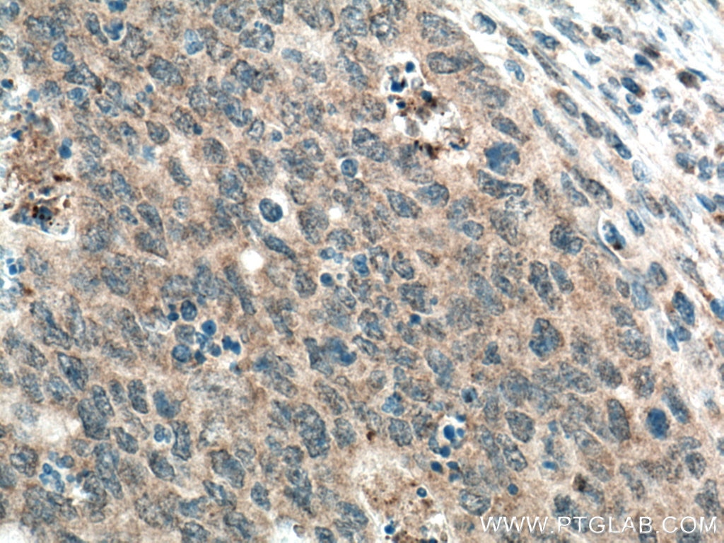 Immunohistochemistry (IHC) staining of human colon cancer tissue using SDC2 Monoclonal antibody (67088-1-Ig)
