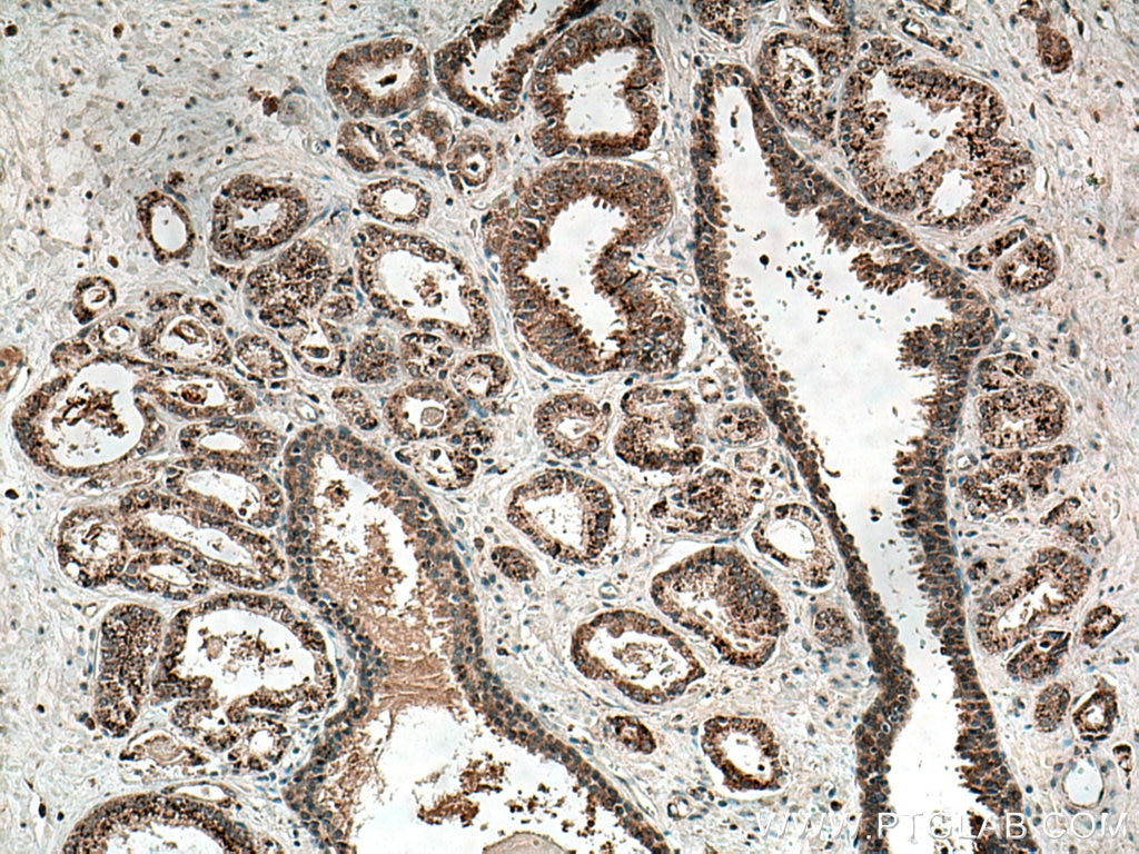 Immunohistochemistry (IHC) staining of human prostate cancer tissue using SDC2 Monoclonal antibody (67088-1-Ig)