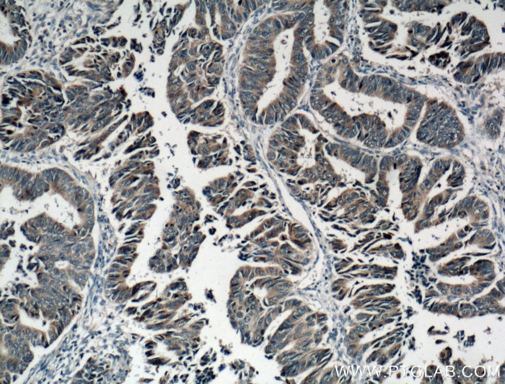 IHC staining of human colon cancer using 10886-1-AP