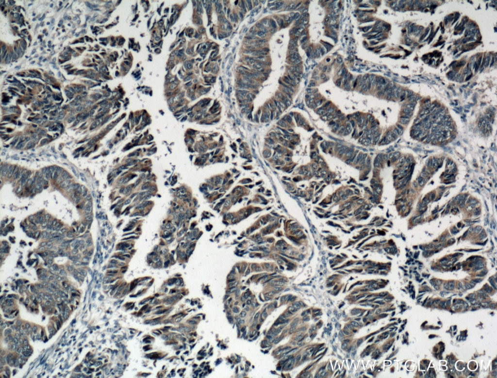 Immunohistochemistry (IHC) staining of human colon cancer tissue using Syndecan-3 Polyclonal antibody (10886-1-AP)