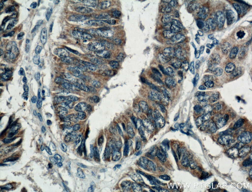 Immunohistochemistry (IHC) staining of human colon cancer tissue using Syndecan-3 Polyclonal antibody (10886-1-AP)