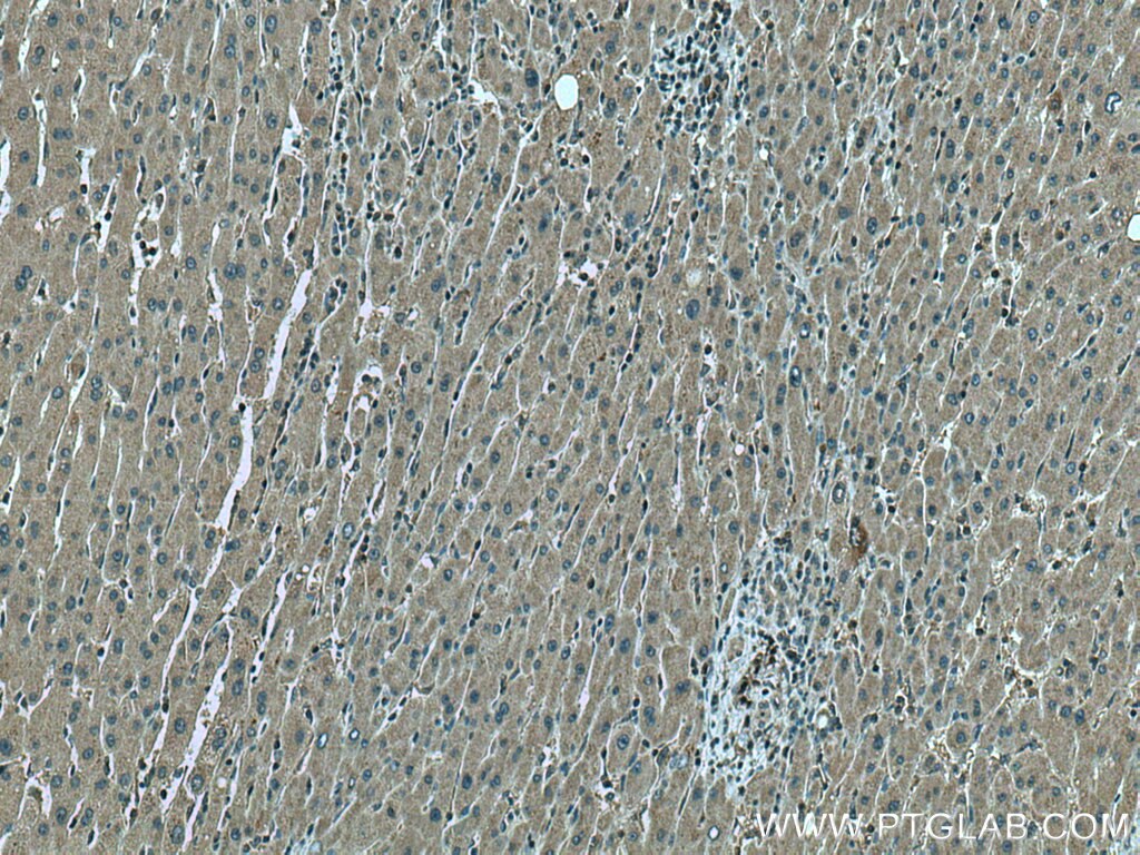 Immunohistochemistry (IHC) staining of human liver cancer tissue using SDC4 Polyclonal antibody (11820-1-AP)