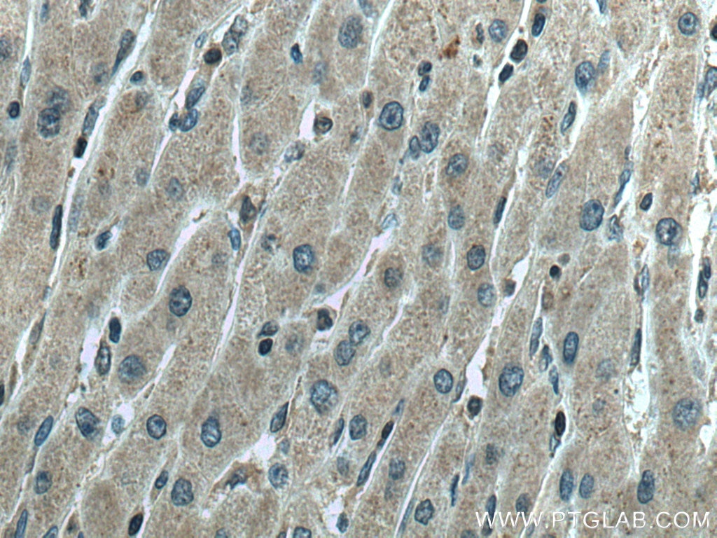 IHC staining of human liver cancer using 11820-1-AP