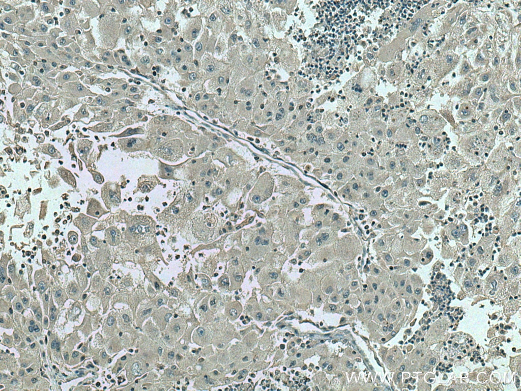 Immunohistochemistry (IHC) staining of human liver cancer tissue using SDC4 Polyclonal antibody (11820-1-AP)