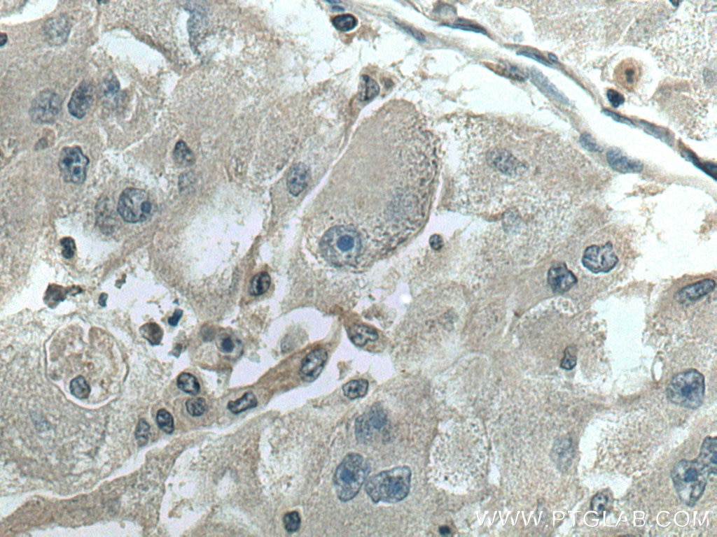 Immunohistochemistry (IHC) staining of human liver cancer tissue using SDC4 Polyclonal antibody (11820-1-AP)