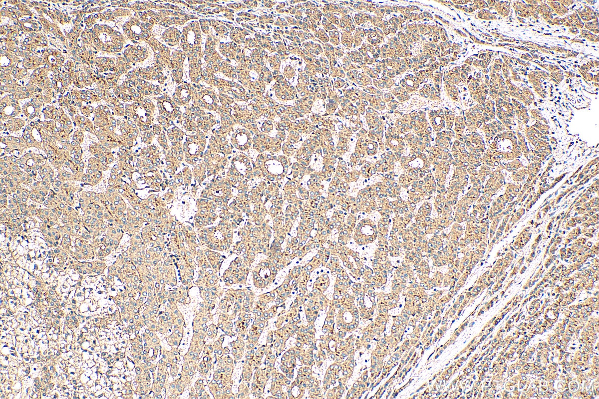 Immunohistochemistry (IHC) staining of human liver cancer tissue using Syntenin-1 Polyclonal antibody (22399-1-AP)