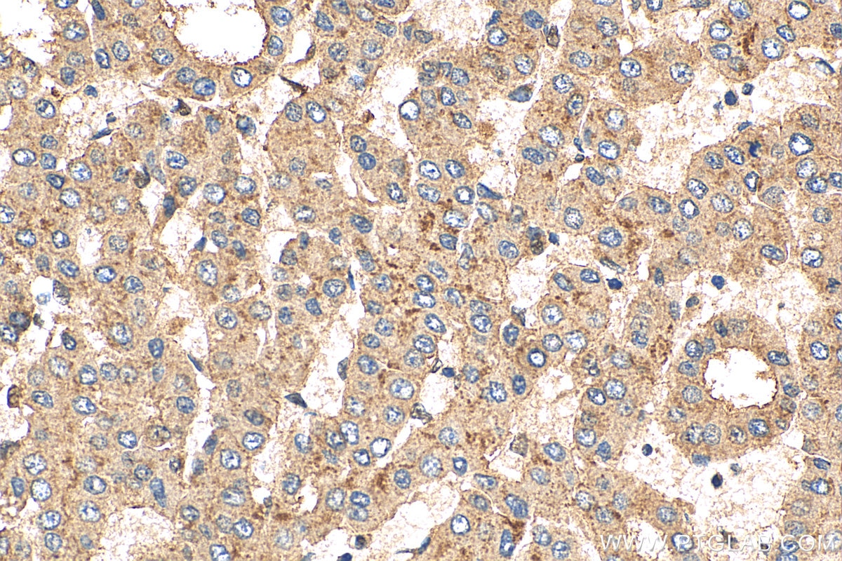 Immunohistochemistry (IHC) staining of human liver cancer tissue using Syntenin-1 Polyclonal antibody (22399-1-AP)