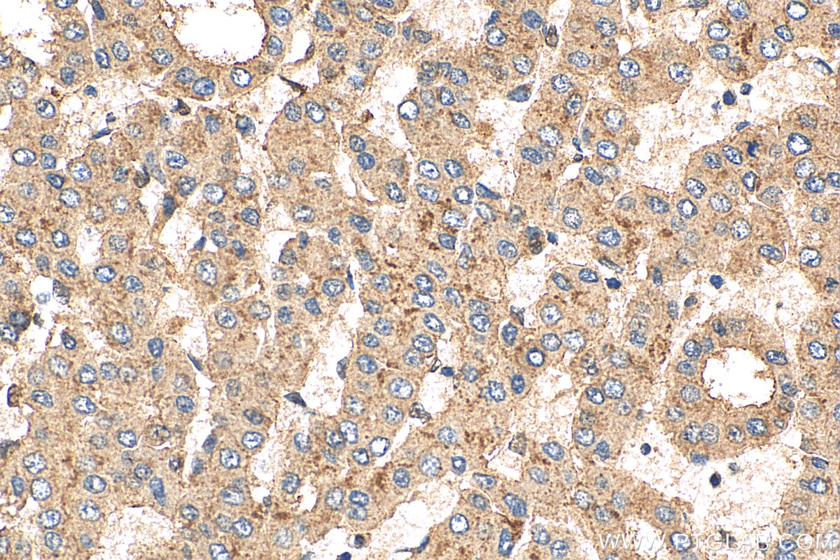 IHC staining of human liver cancer using 22399-1-AP