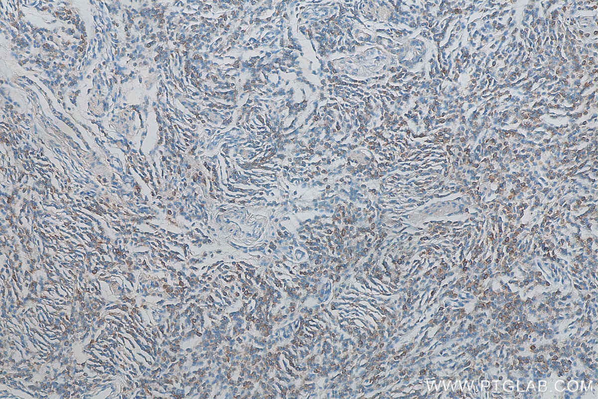 Immunohistochemistry (IHC) staining of human malignant melanoma tissue using Syntenin-1 Monoclonal antibody (68096-1-Ig)