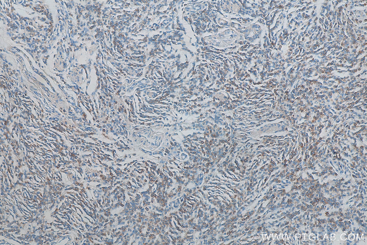 IHC staining of human malignant melanoma using 68096-1-Ig