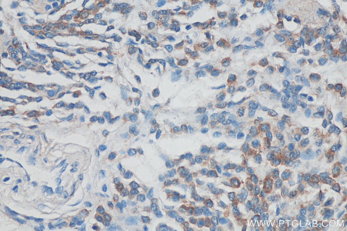 Immunohistochemistry (IHC) staining of human malignant melanoma tissue using Syntenin-1 Monoclonal antibody (68096-1-Ig)