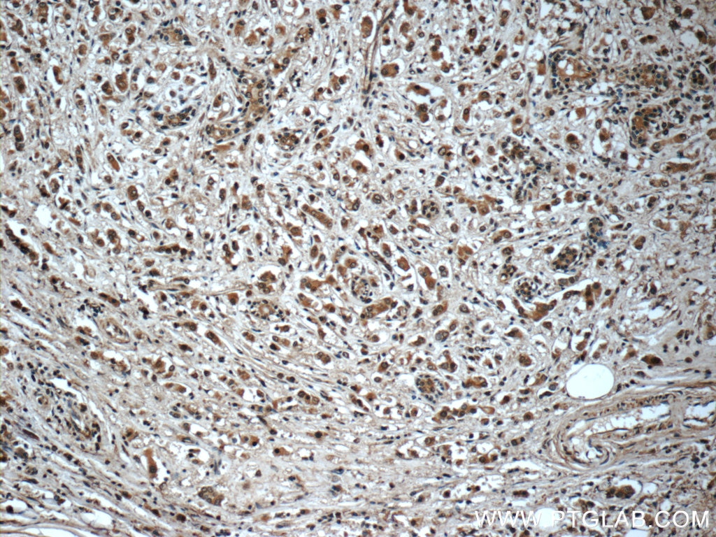 IHC staining of human breast cancer using 10407-1-AP