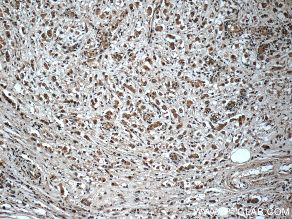 Immunohistochemistry (IHC) staining of human breast cancer tissue using Syntenin 2 Polyclonal antibody (10407-1-AP)