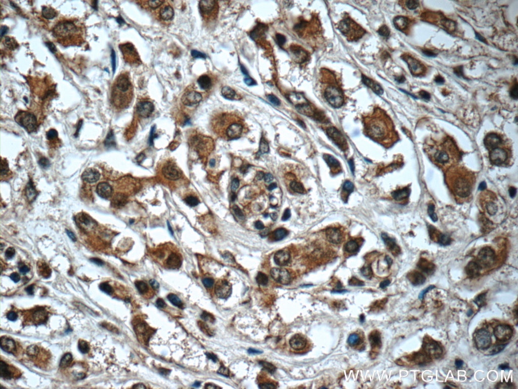 Immunohistochemistry (IHC) staining of human breast cancer tissue using Syntenin 2 Polyclonal antibody (10407-1-AP)