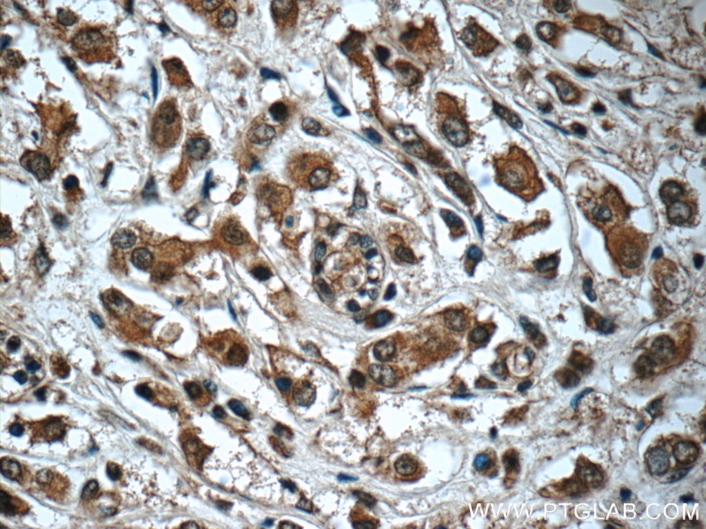 IHC staining of human breast cancer using 10407-1-AP