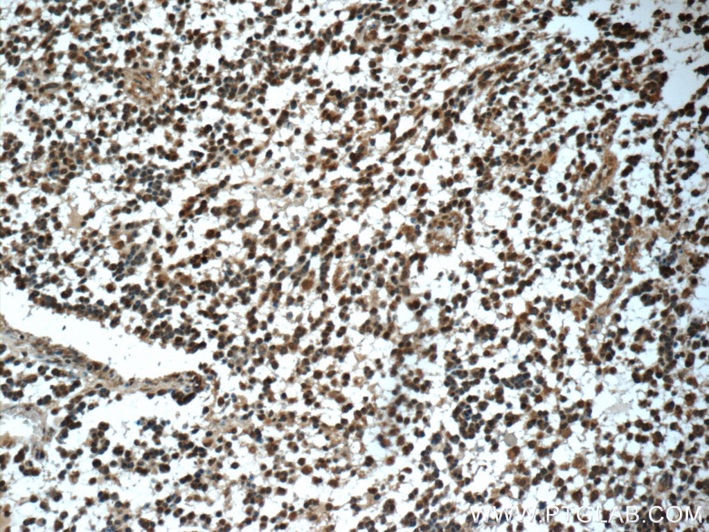 Immunohistochemistry (IHC) staining of human gliomas tissue using Syntenin 2 Polyclonal antibody (10407-1-AP)