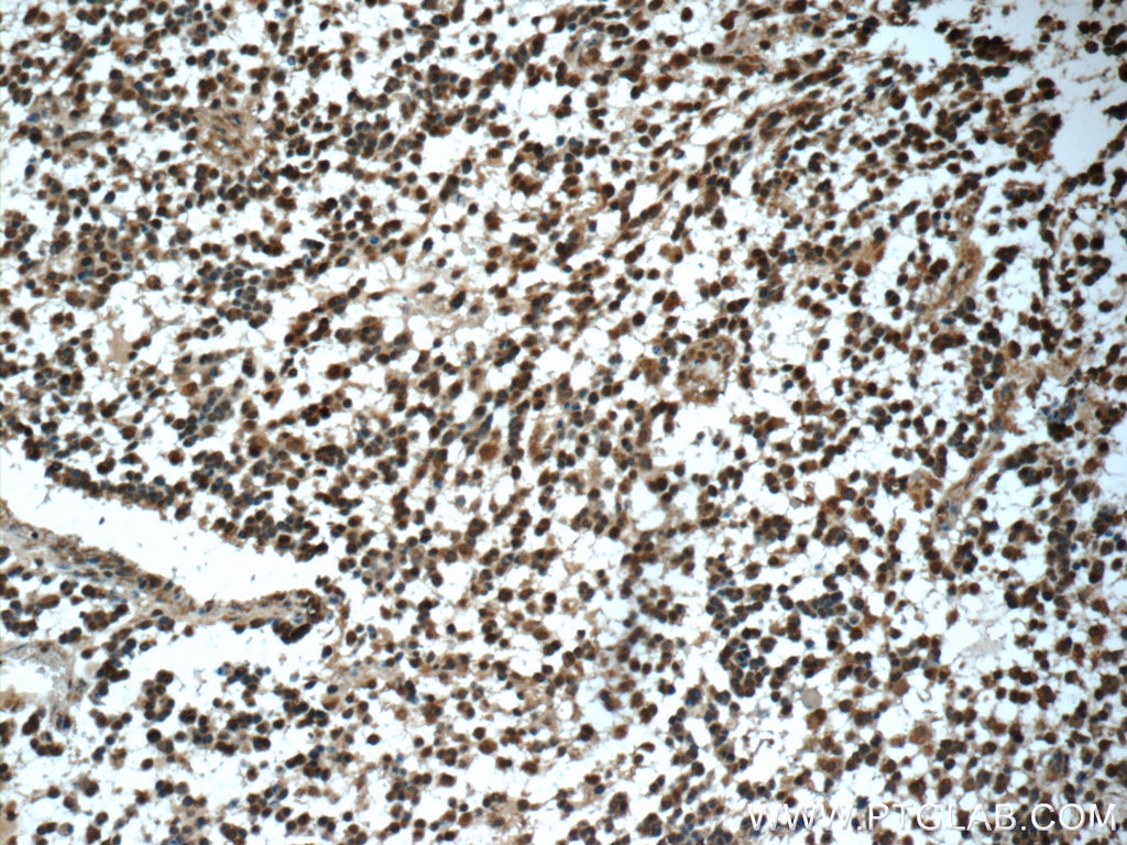Immunohistochemistry (IHC) staining of human gliomas tissue using Syntenin 2 Polyclonal antibody (10407-1-AP)