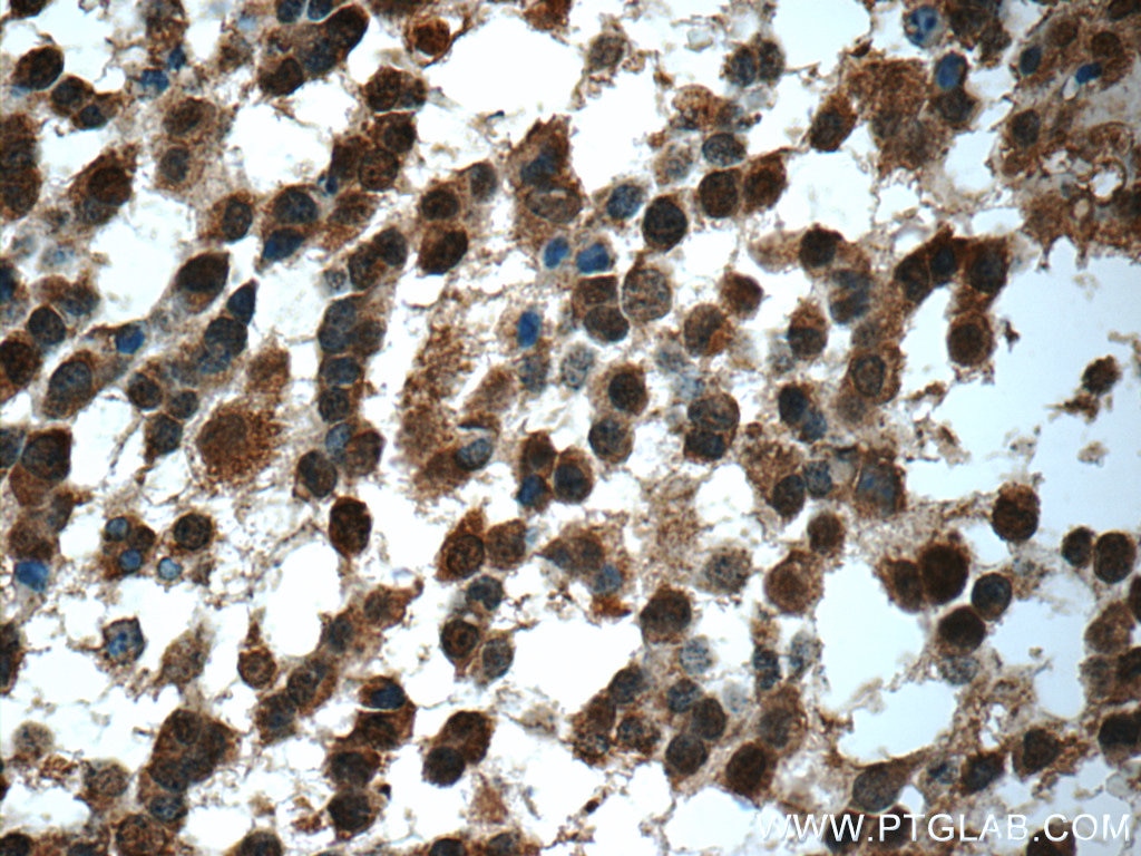 IHC staining of human gliomas using 10407-1-AP