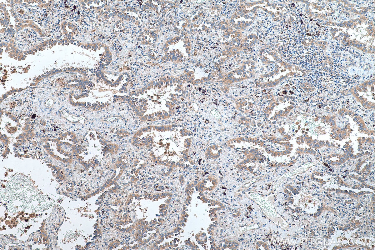 Immunohistochemistry (IHC) staining of human lung cancer tissue using SDCCAG1 Polyclonal antibody (11840-1-AP)