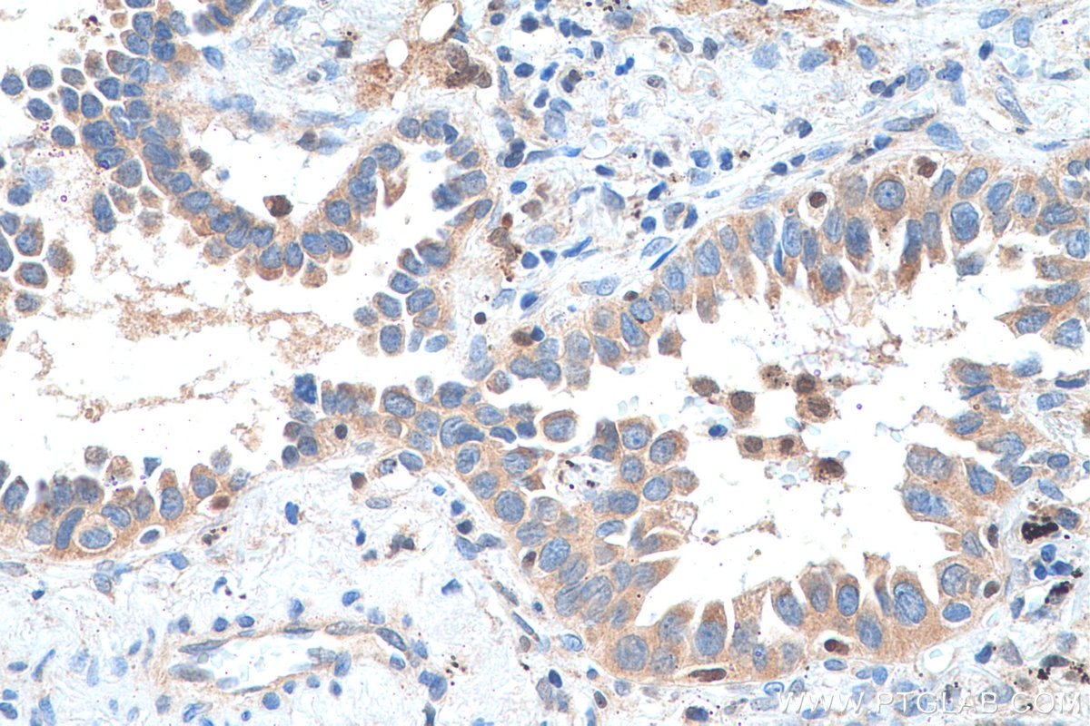 Immunohistochemistry (IHC) staining of human lung cancer tissue using SDCCAG1 Polyclonal antibody (11840-1-AP)