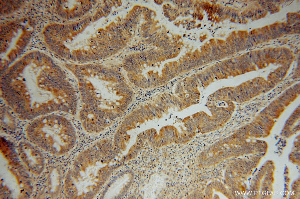 Immunohistochemistry (IHC) staining of human colon cancer tissue using SDCCAG3 Polyclonal antibody (15969-1-AP)