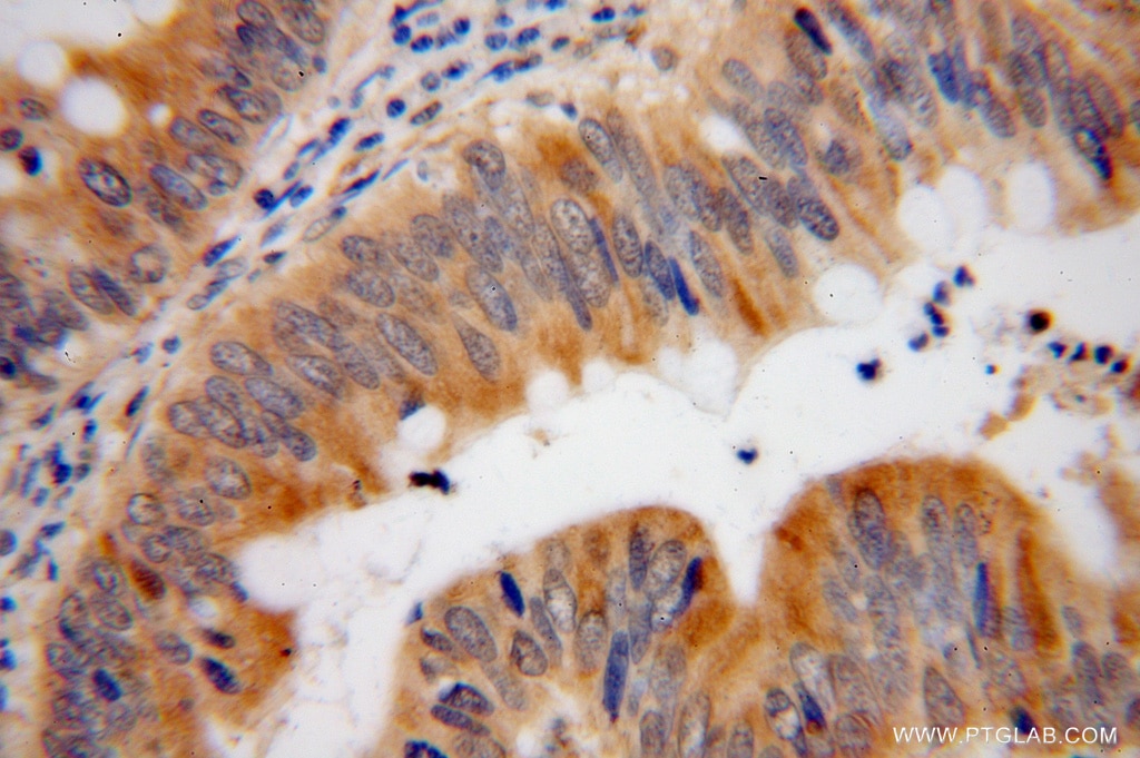 Immunohistochemistry (IHC) staining of human colon cancer tissue using SDCCAG3 Polyclonal antibody (15969-1-AP)