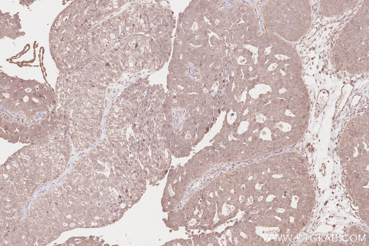 IHC staining of human ovary cancer using 13471-1-AP Immunohistochemistry (IHC) staining of human ovary cancer tissue using SDCCAG8 Polyclonal antibody (13471-1-AP)