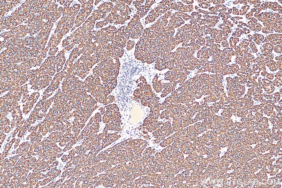 Immunohistochemistry (IHC) staining of human liver cancer tissue using SDHA Polyclonal antibody (14865-1-AP)