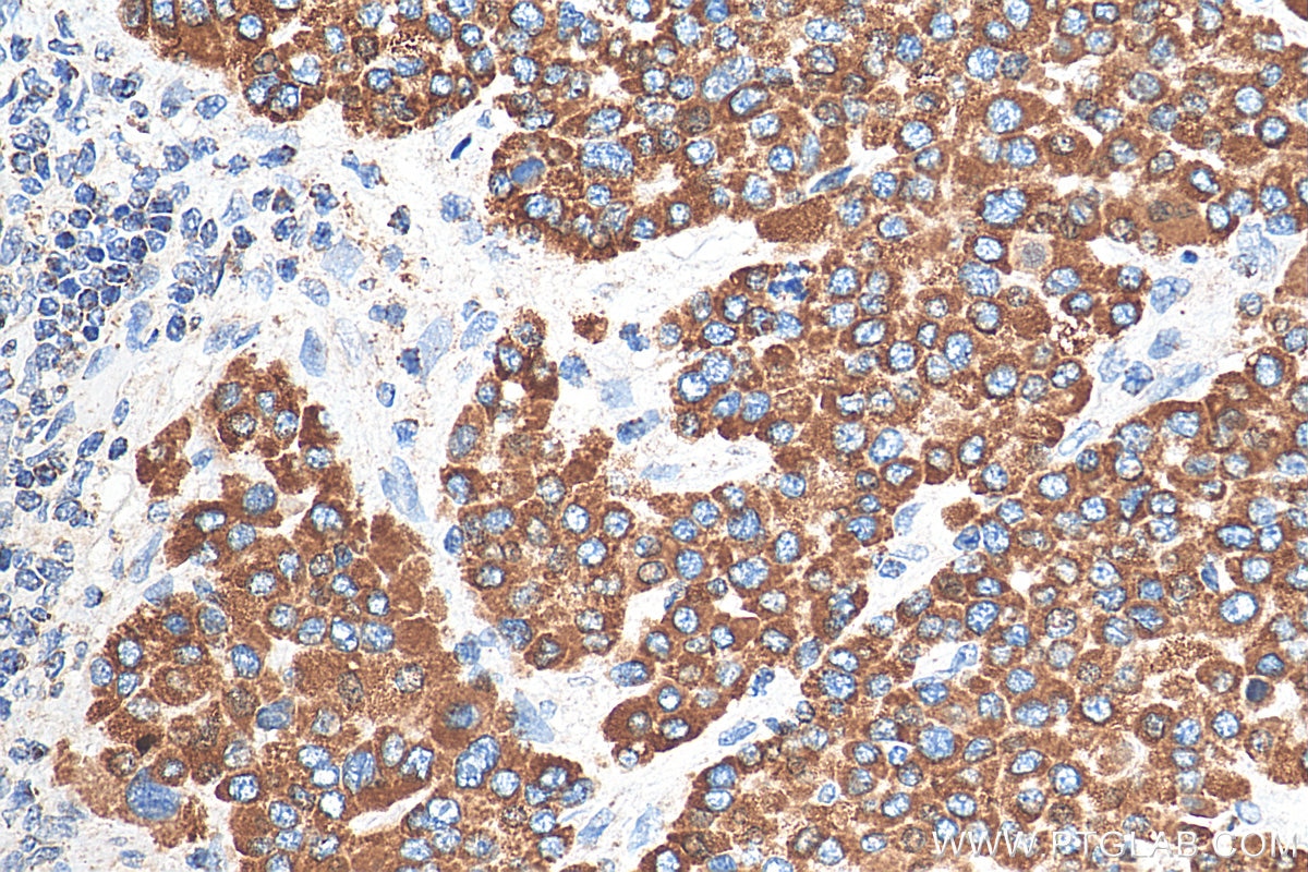 Immunohistochemistry (IHC) staining of human liver cancer tissue using SDHA Polyclonal antibody (14865-1-AP)