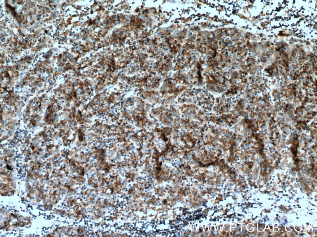 Immunohistochemistry (IHC) staining of human liver cancer tissue using SDHA Polyclonal antibody (14865-1-AP)