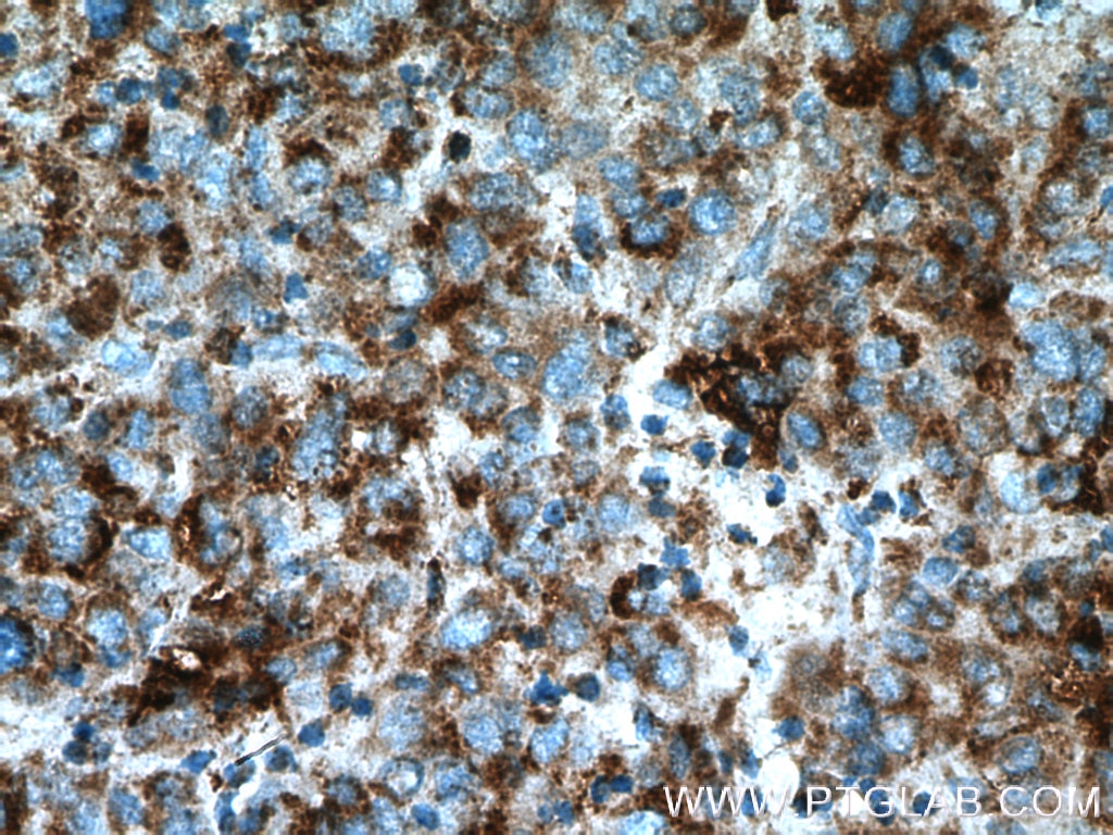 Immunohistochemistry (IHC) staining of human liver cancer tissue using SDHA Polyclonal antibody (14865-1-AP)