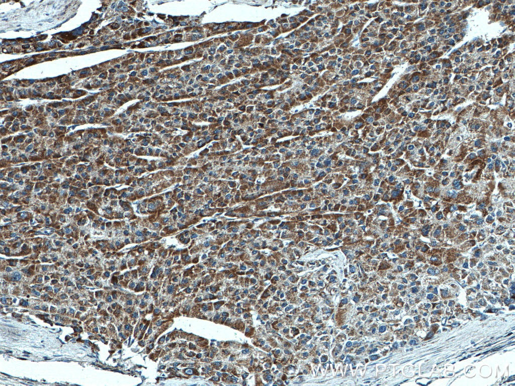 Immunohistochemistry (IHC) staining of human liver cancer tissue using SDHA Monoclonal antibody (66588-1-Ig)