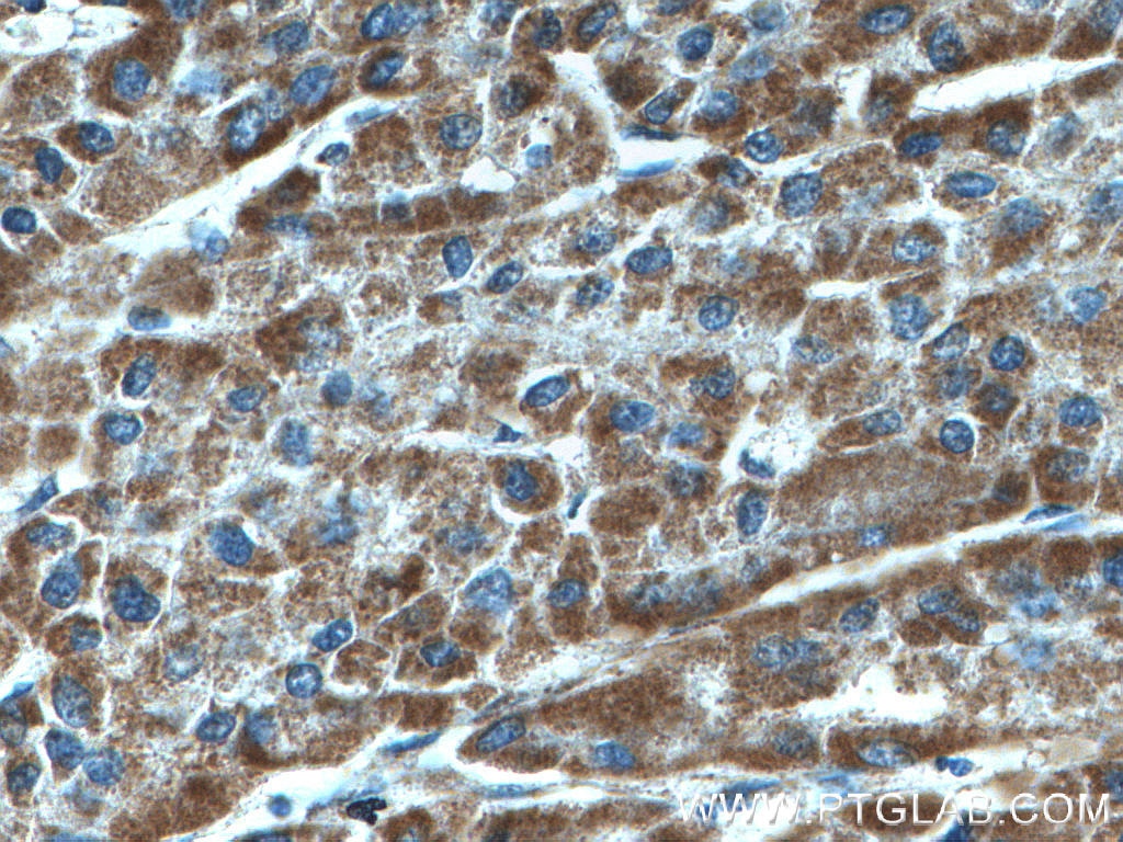 Immunohistochemistry (IHC) staining of human liver cancer tissue using SDHA Monoclonal antibody (66588-1-Ig)