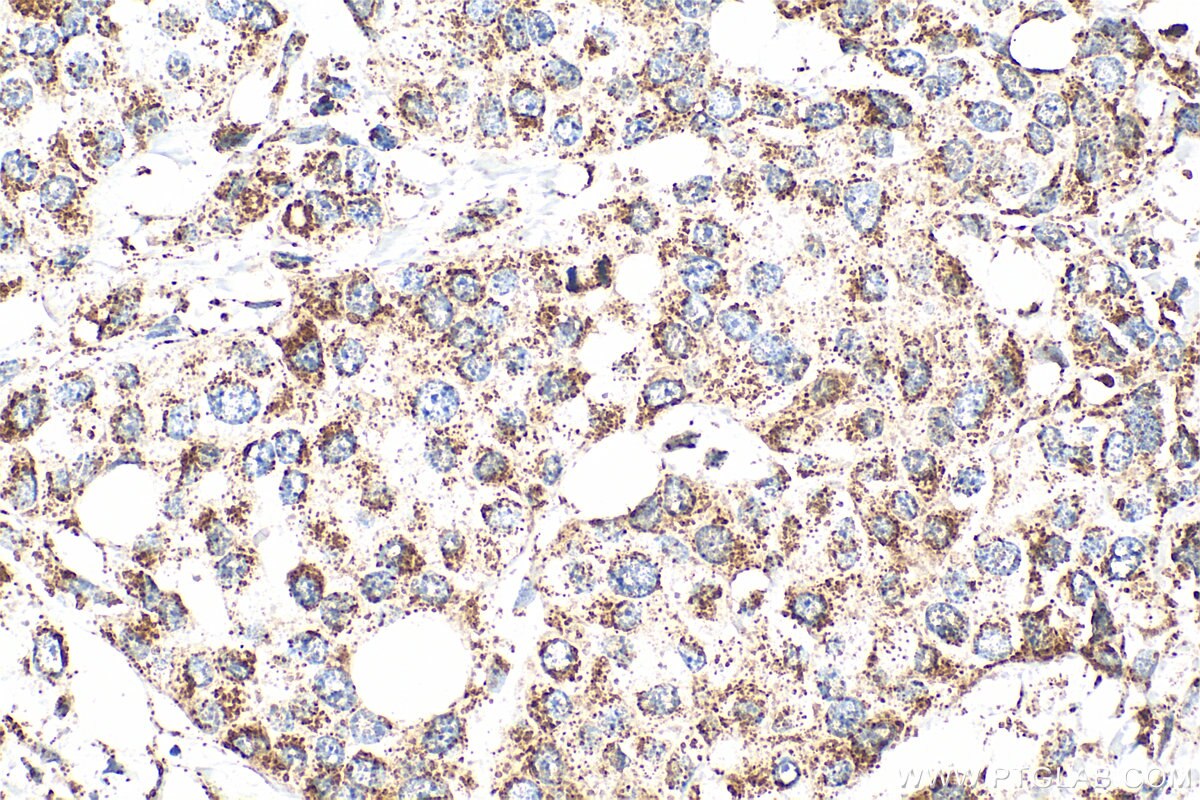 Immunohistochemical analysis of paraffin-embedded human breast cancer tissue slide using 30663-1-AP (C6orf57 antibody) at dilution of 1:200 (under 40x lens). Heat mediated antigen retrieval with Tris-EDTA buffer (pH 9.0). Immunohistochemistry (IHC) staining of human breast cancer tissue using SDHAF4 Polyclonal antibody (30663-1-AP)