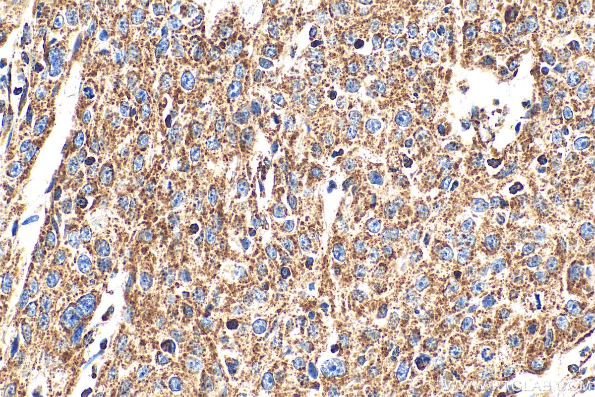 Immunohistochemical analysis of paraffin-embedded human cervical cancer tissue slide using 30663-1-AP (C6orf57 antibody) at dilution of 1:200 (under 40x lens). Heat mediated antigen retrieval with Tris-EDTA buffer (pH 9.0). Immunohistochemistry (IHC) staining of human cervical cancer tissue using SDHAF4 Polyclonal antibody (30663-1-AP)