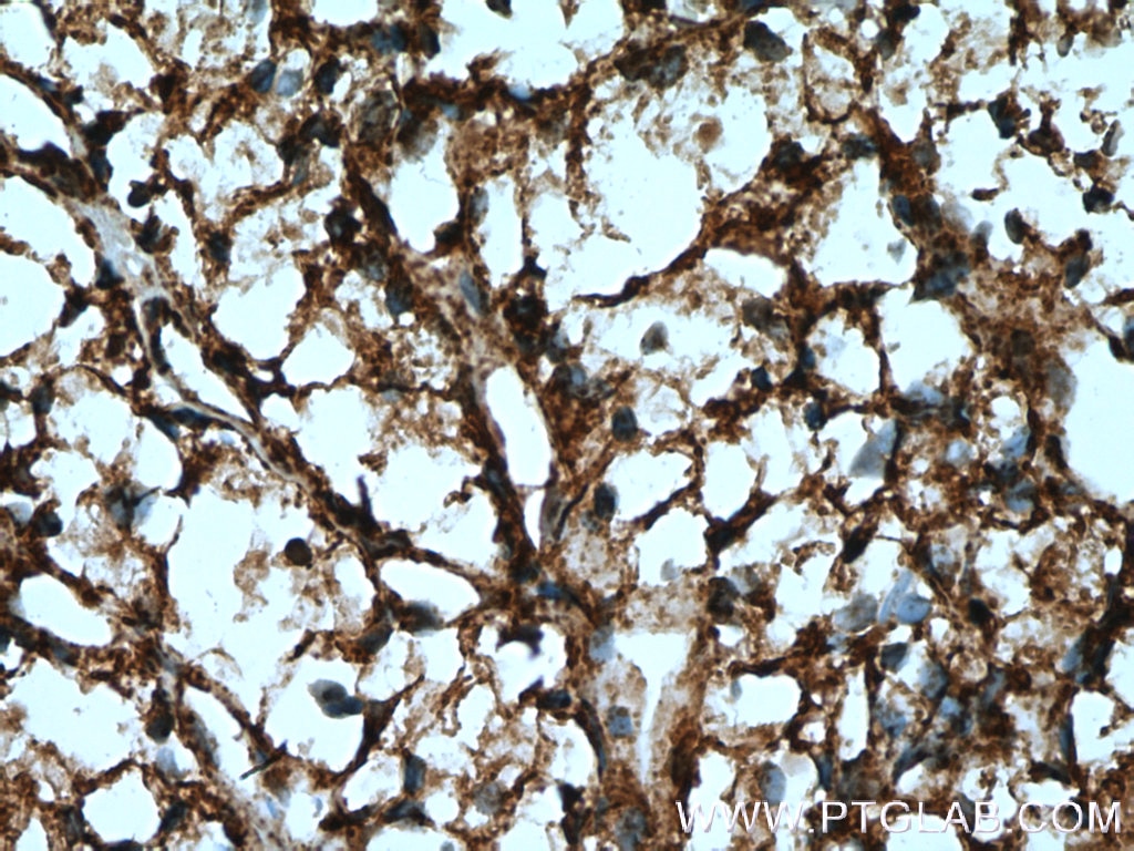 Immunohistochemistry (IHC) staining of human renal cell carcinoma tissue using SDHB Polyclonal antibody (10620-1-AP)