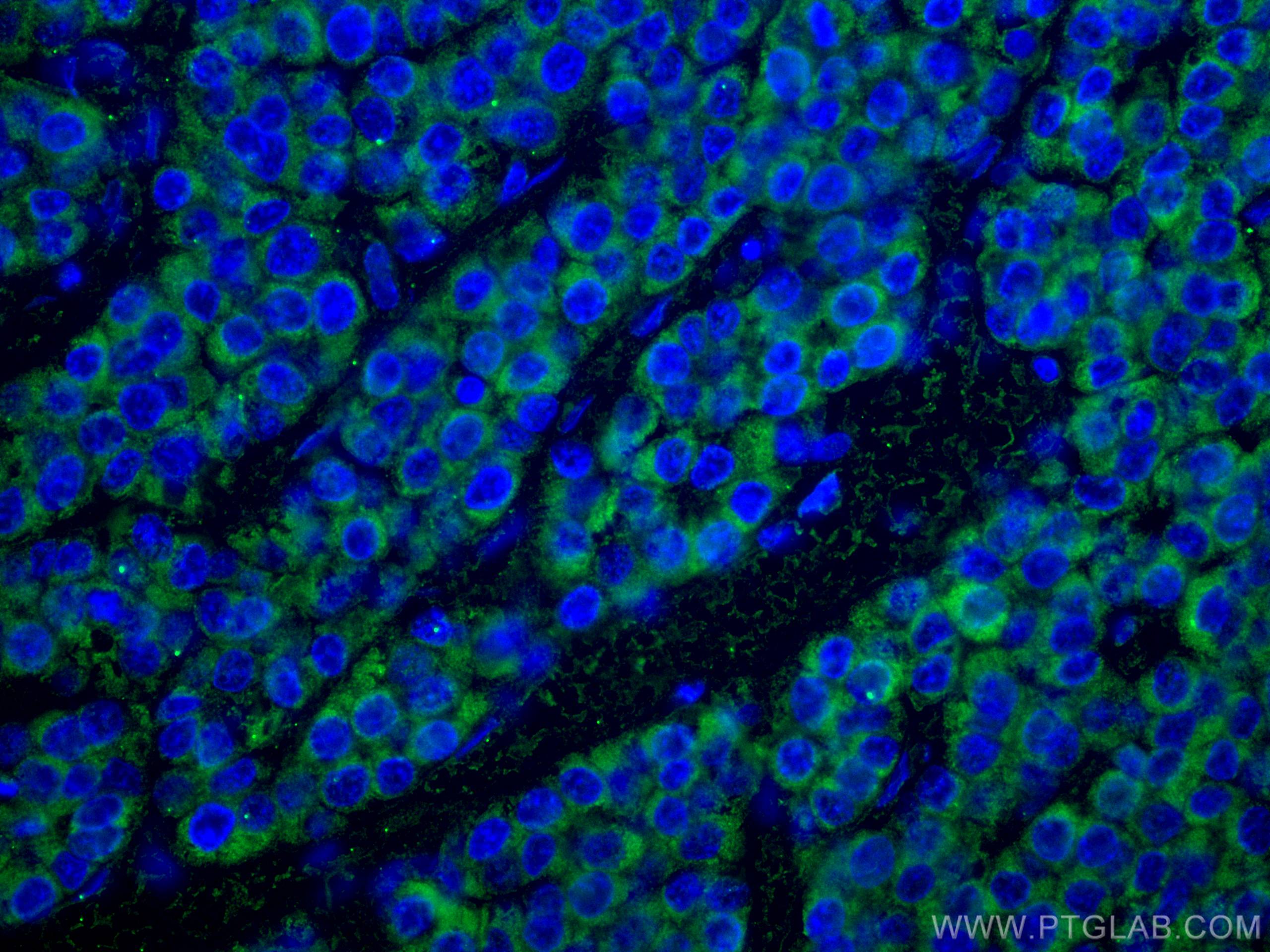 Immunofluorescence (IF) / fluorescent staining of human liver cancer tissue using SDHB Monoclonal antibody (67600-1-Ig)