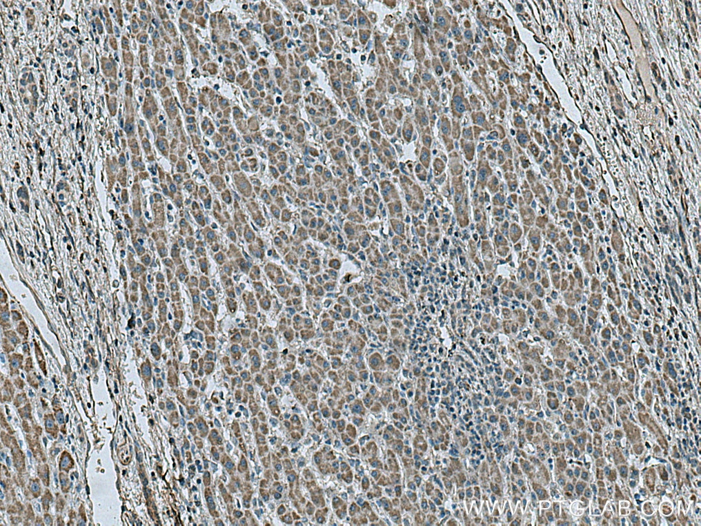 Immunohistochemistry (IHC) staining of human liver cancer tissue using SDHB Monoclonal antibody (67600-1-Ig)