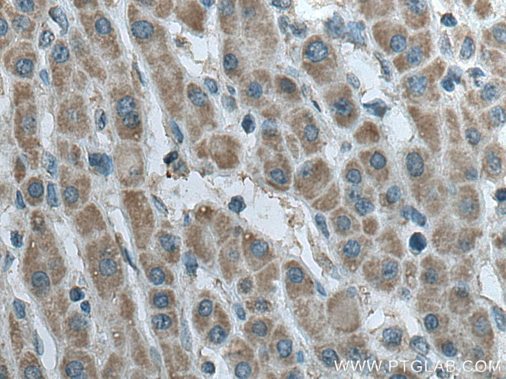 Immunohistochemistry (IHC) staining of human liver cancer tissue using SDHB Monoclonal antibody (67600-1-Ig)