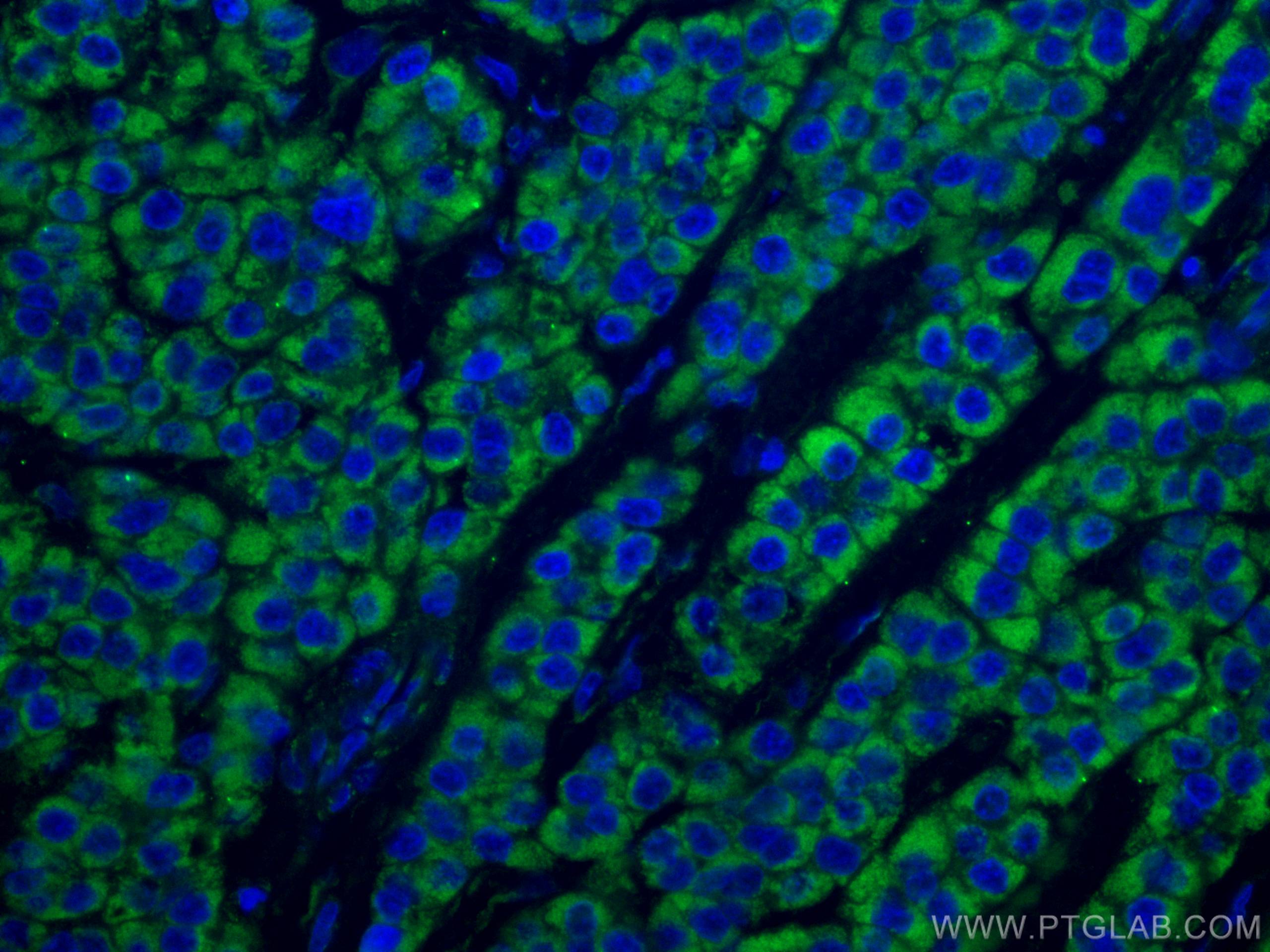 Immunofluorescence (IF) / fluorescent staining of human liver cancer tissue using CoraLite® Plus 488-conjugated SDHB Monoclonal anti (CL488-67600)