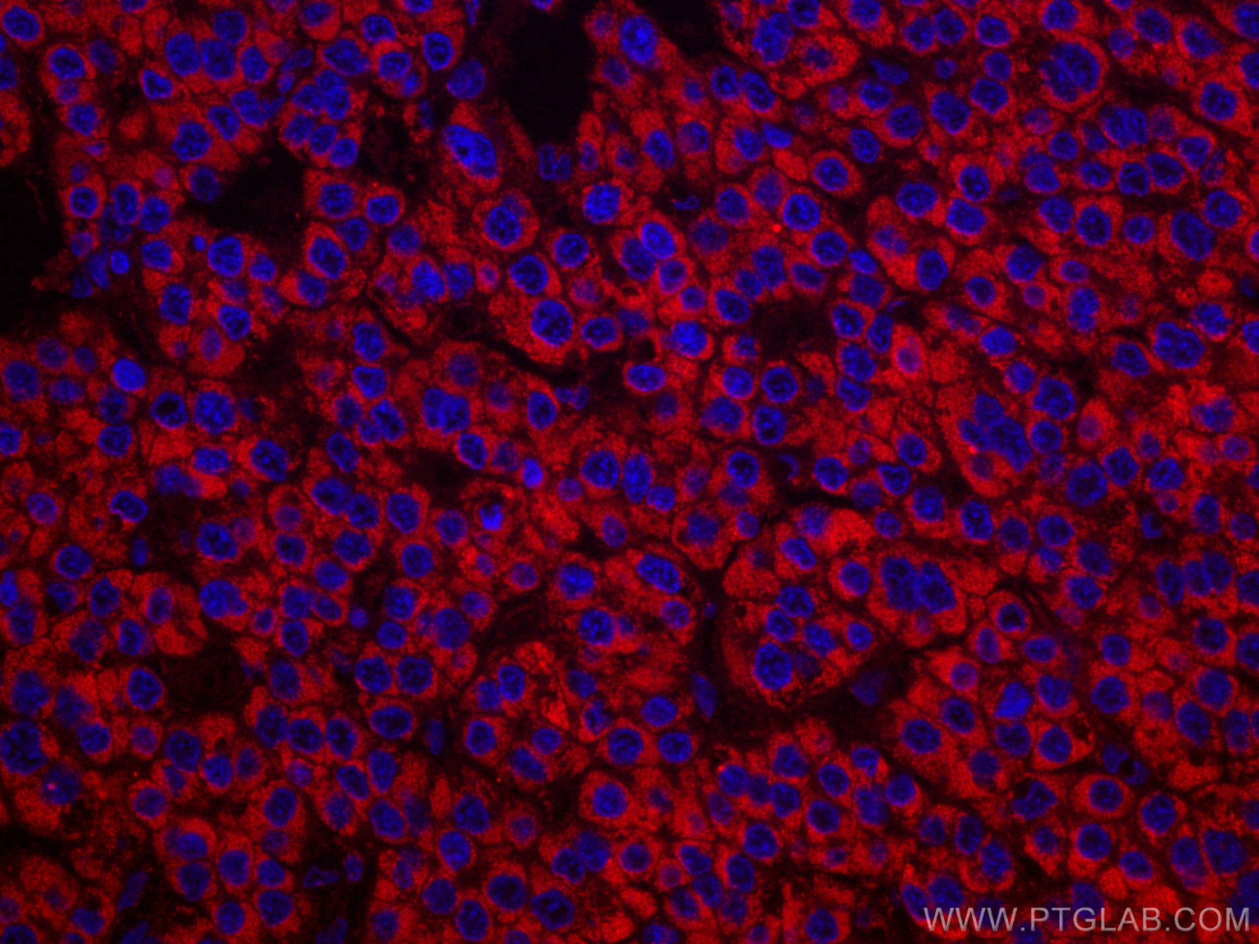 Immunofluorescence (IF) / fluorescent staining of human liver cancer tissue using CoraLite®594-conjugated SDHB Monoclonal antibody (CL594-67600)