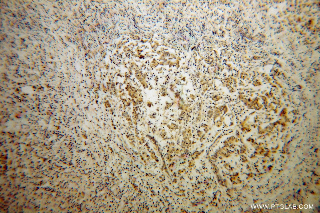 Immunohistochemistry (IHC) staining of human breast cancer tissue using SDHC Polyclonal antibody (14575-1-AP)